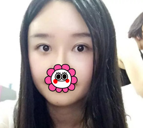 杭州瑞丽双眼皮+面部脂肪填充术后1个月