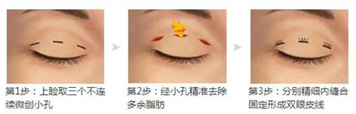韩式三点双眼皮手术过程