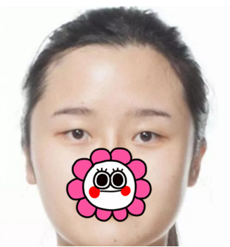 杭州瑞丽双眼皮+面部脂肪填充术前