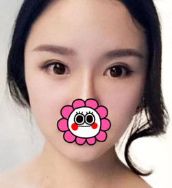 杭州瑞丽双眼皮+面部脂肪填充术后2个月