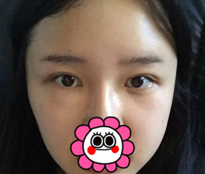 杭州瑞丽双眼皮+面部脂肪填充术后23天