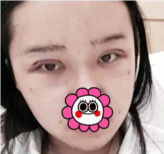 杭州瑞丽双眼皮+面部脂肪填充术后6天