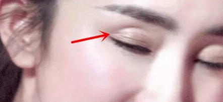 双眼皮贴容易暴露