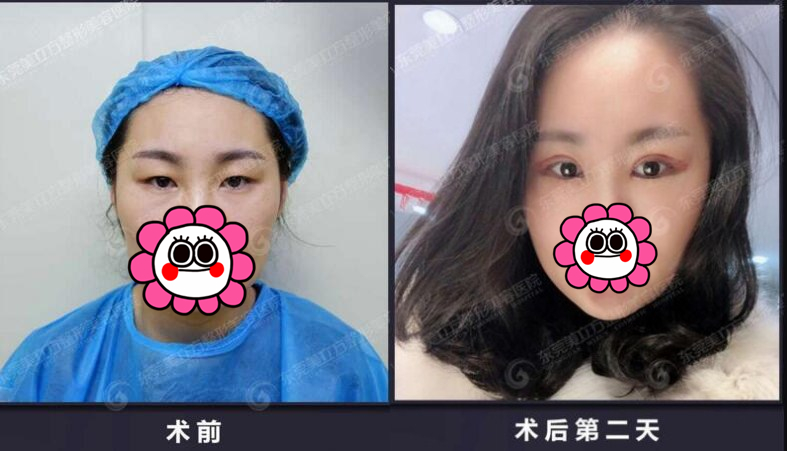 东莞美立方双眼皮整形案例