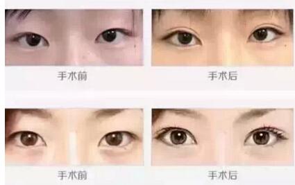 青海康华双眼皮加开眼角案例