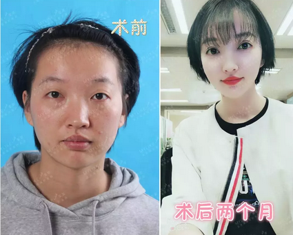 北京美莱整形医院叶宇双眼皮案例前后对比图