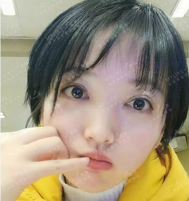 北京美莱整形医院叶宇双眼皮案例两个月