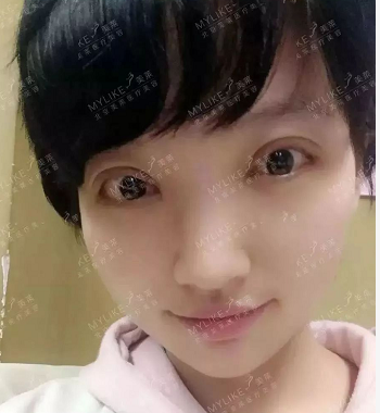 北京美莱整形医院叶宇双眼皮术后