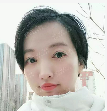 北京美莱整形医院叶宇双眼皮一个月