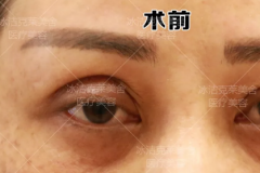 看了北京张冰洁做眼部修复案例效果后找她做了双眼皮修复