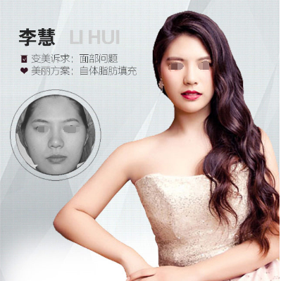 乌鲁木齐华美自体脂肪填充案例