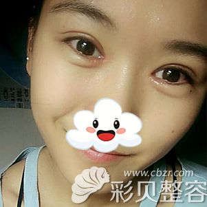 西安华旗唯美张沙沙双眼皮案例