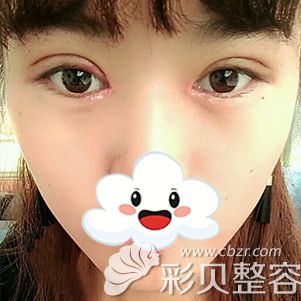 西安华旗唯美张沙沙双眼皮案例