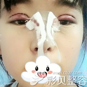 西安华旗唯美张沙沙双眼皮案例