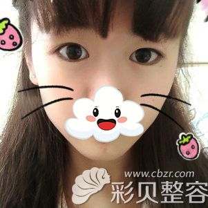 西安华旗唯美张沙沙双眼皮案例