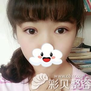西安华旗唯美张沙沙双眼皮案例