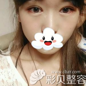 西安华旗唯美张沙沙双眼皮案例