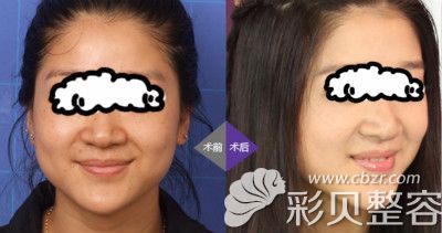 激光祛斑案例效果图