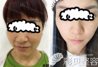 福州台江激光祛斑效果图