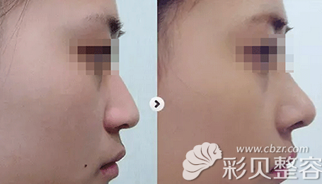 <i data-id=8849dbc2-8c09-482e-be55-e5f61db7fb04></i>整形鼻综合前后效果对比图