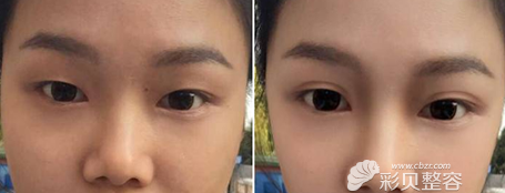 <i data-id=8849dbc2-8c09-482e-be55-e5f61db7fb04></i>整形双眼皮前后效果对比图