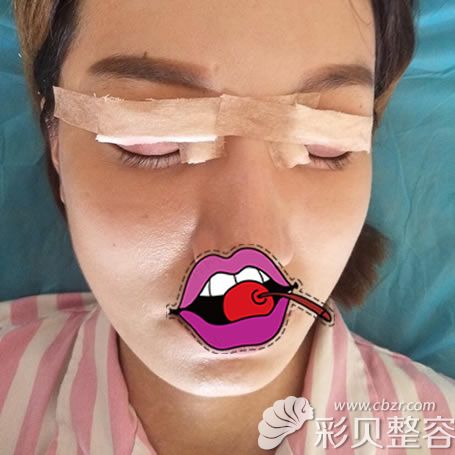 切开双眼皮天