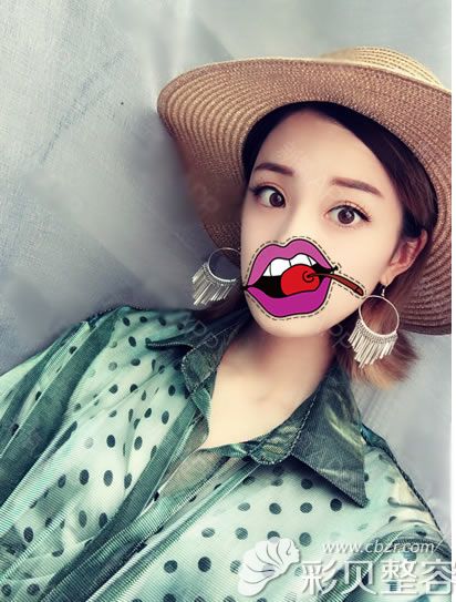 切开双眼皮加内眼角30天