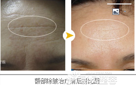东莞知美整形微针美塑治疗额头除皱前后效果对比