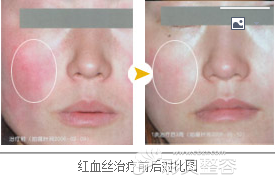 东莞知美整形微针美塑治疗红血丝前后效果对比
