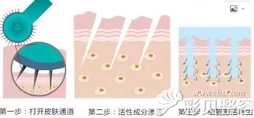 东莞知美微针美塑过程图