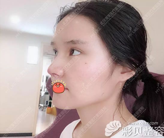 自体肋软骨鼻综合整形30天