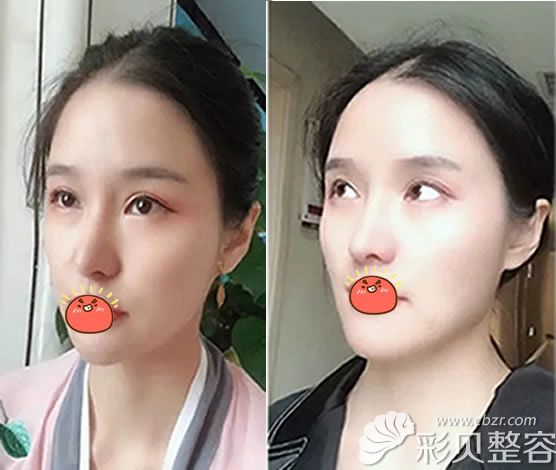 自体肋软骨鼻综合整形90天
