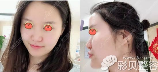 自体肋软骨鼻综合手术前