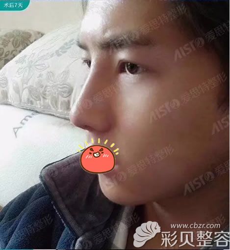 广西爱思特黎冻soul美鼻7天
