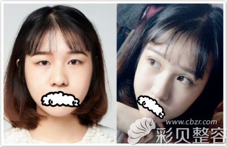 郑州集美双眼皮整形案例