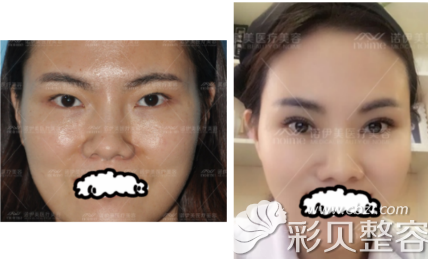呼和浩特诺伊美打瘦脸针整形案例