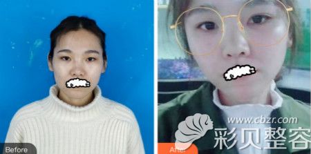 郑州集美鼻综合+双眼皮整形案例