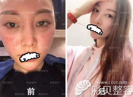 郑州集美皮肤整形美容案例