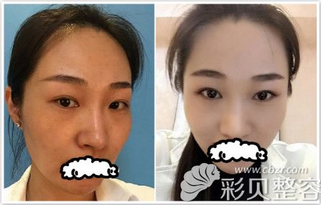 郑州集美激光祛斑整形案例