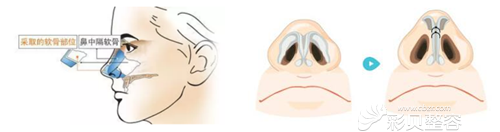 鼻尖整形用哪种材料好?龙海波医生推荐自体软骨垫鼻尖
