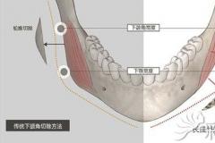 想知道上海华美和上海首尔丽格做下颌角整形哪个好吗