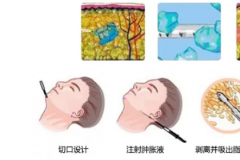 上海哪个医院做面部吸脂术效果好？大概需要多少钱