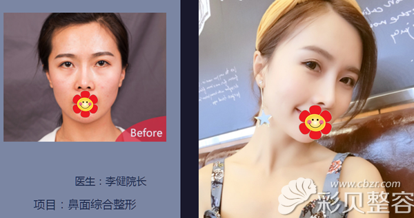 上海华美李健医生隆鼻+自体脂肪面部填充效果怎么样