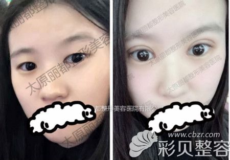 太原丽都杨明锋冰冰媚眼案例赏析
