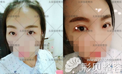 太原丽都杨明锋冰冰媚眼真人案例