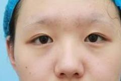 广州名韩整形彭丽霞做玻尿酸隆鼻手术图片及整形价格公布