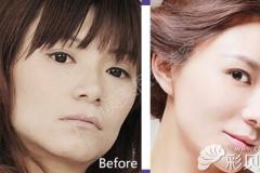 广州美莱郑义解析：面部线雕能维持多久 线雕2年后会显老吗