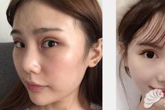 广州美莱郑义解析：面部线雕能维持多久 线雕2年后会显老吗