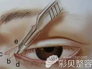 开眼角术后容易出现疤痕增生