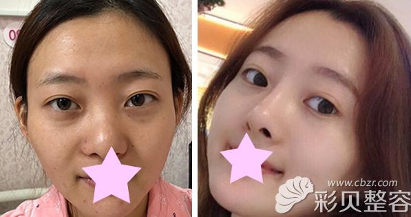 北京米兰柏羽丽都整形鼻综合+耳软骨隆鼻效果案例 北京米兰柏羽丽都整形鼻综合+耳软骨隆鼻效果案例